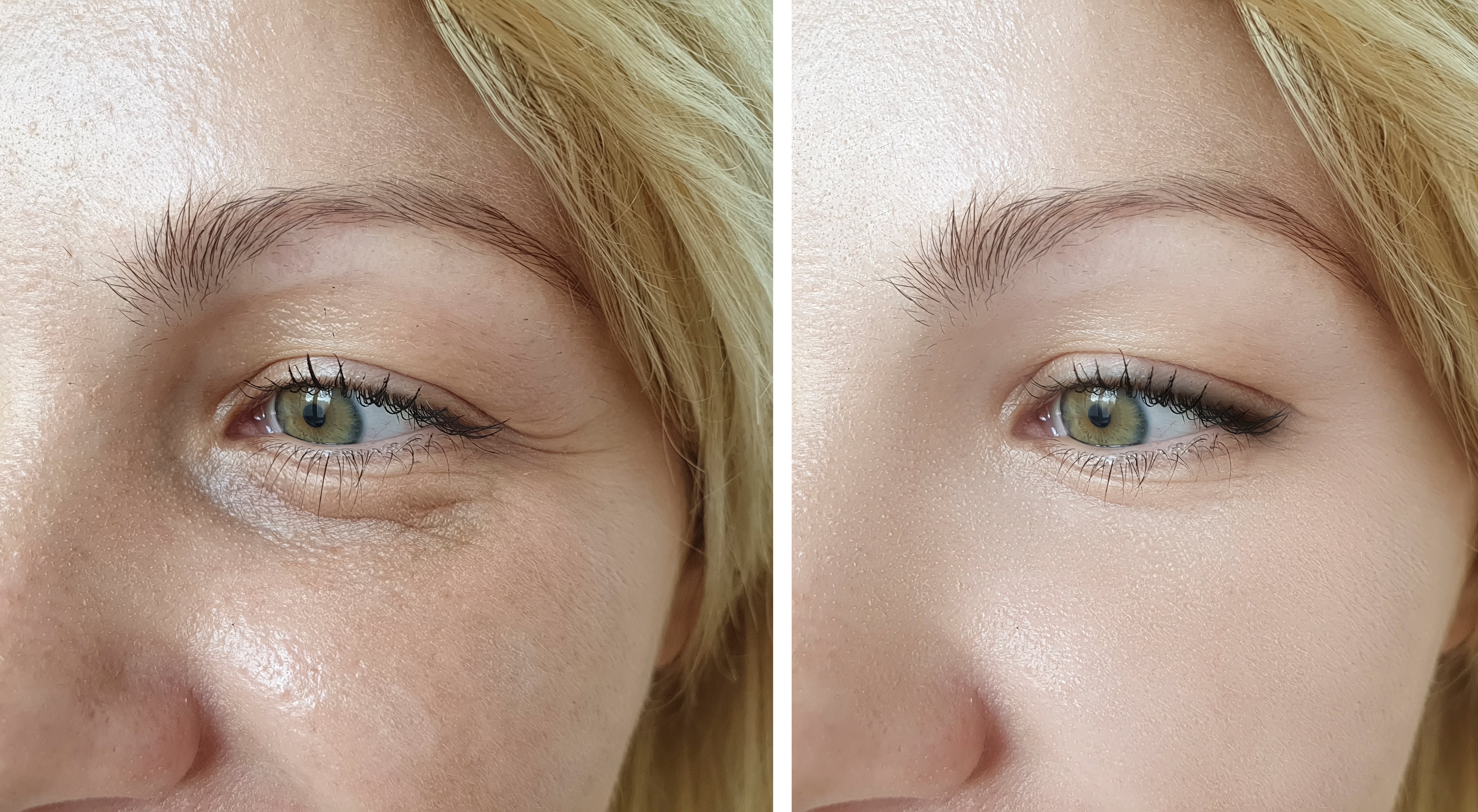 files/Skin_difference_before_after_31a6df2e-53d4-427d-9456-2839a3fed498.jpg